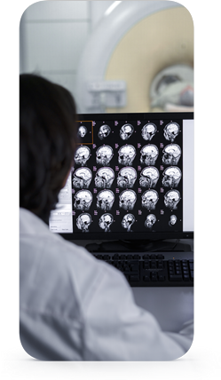 Epilepsia